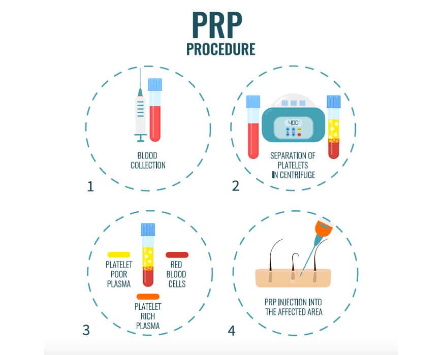Platelet-Rich-Plasma-PRP-Therapy-procedure-infographic